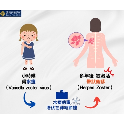 帶狀泡疹.jpg