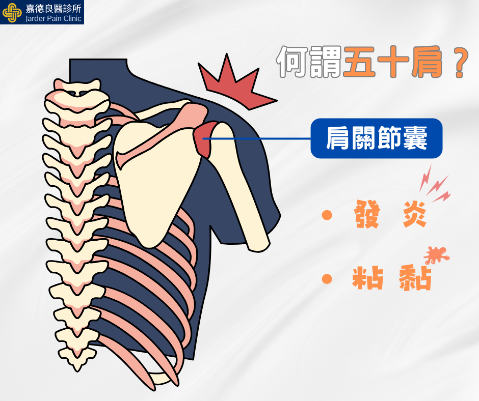 什麼是五十肩