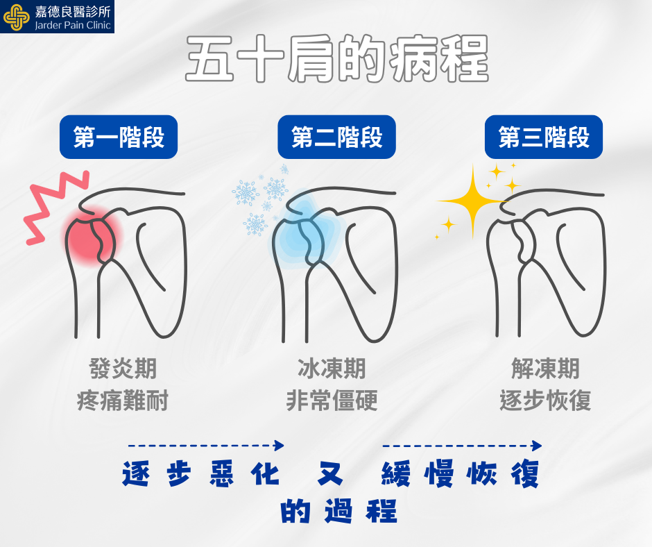 五十肩的病程