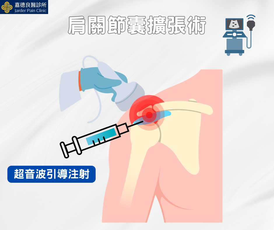 肩關節囊擴張術