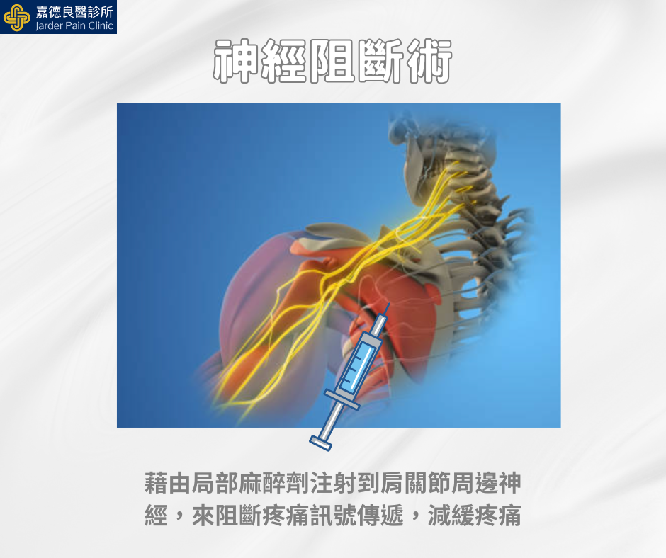 神經阻斷術