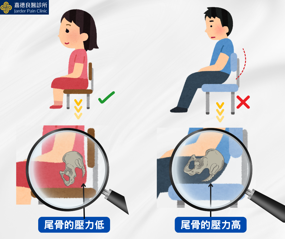 尾骨壓力高