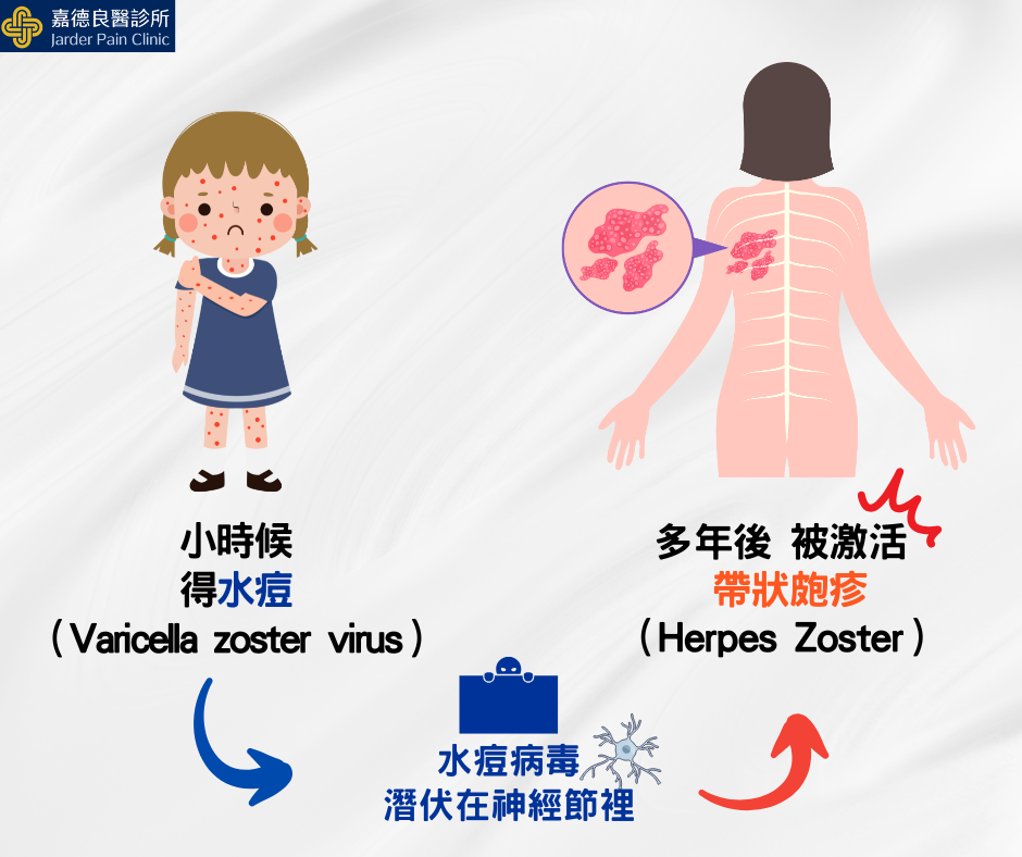 帶狀皰疹